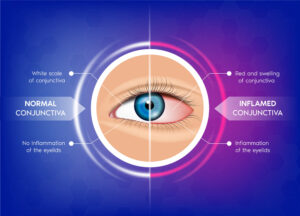 Pink Eye Infection Precautions for Students